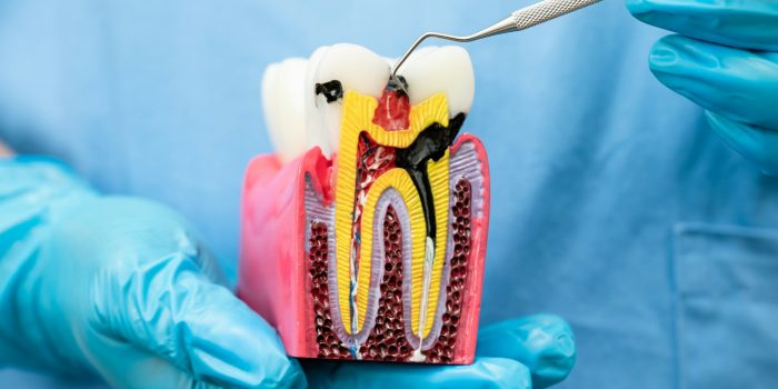 Asian dentist holding dental implant, artificial tooth roots into jaw, root canal of dental