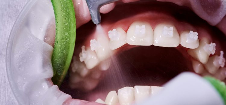 Close-up picture of a woman's mouth during dental procedure of cleaning teeth