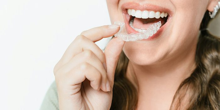 Woman Inserting Clear Teeth Aligner